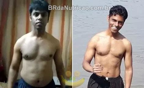 Lipomastia Antes E Depois - Lipomastia Antes E Depois , Entenda O Que é A Lipomastia E Como Tratar ...