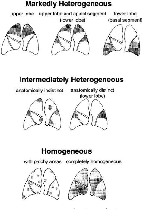 Figure 1 From Classification Of Emphysema In Candidates For Lung Volume