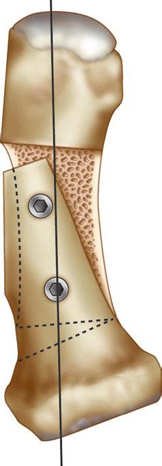 18 Scarf osteotomy. Fixation for the scarf osteotomy is typically with... | Download Scientific ...