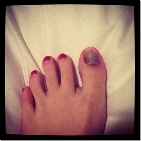 Melanoma toenail images - Awesome Nail