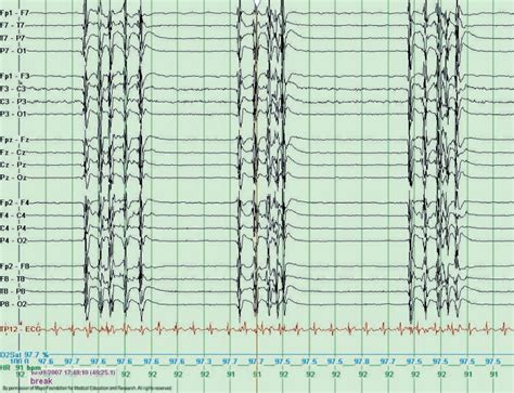 Eeg Burst Suppression