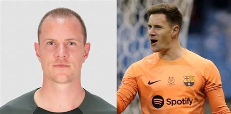 Marc André ter Stegen Hair Transplant Everything You Need to Know