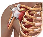 Curar Tendinitis Causas Del Hombro Doloroso Tendinitis