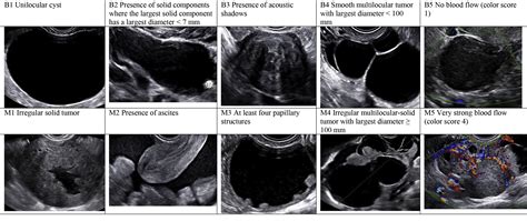 Ovarian Mass Differentiating Benign From Malignant The Value Of The