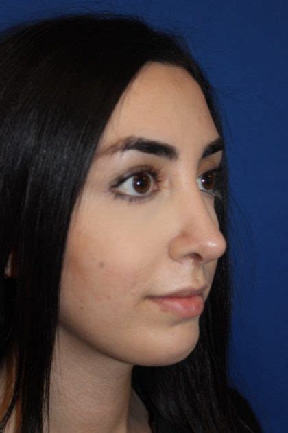 Patient Rhinoplasty Before And After Photos La Jolla Plastic