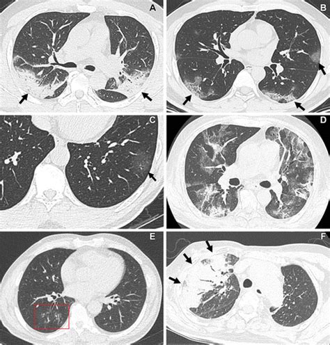 Current And Emerging Knowledge In COVID 19 Radiology