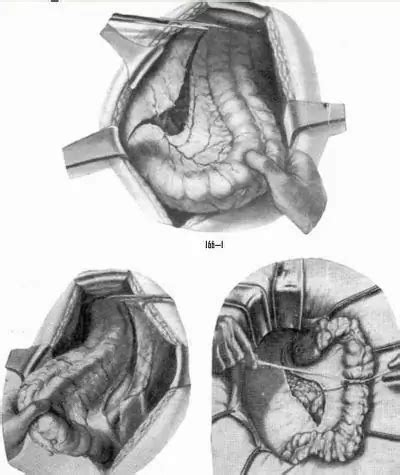 hartmann operation description stages technique medicine