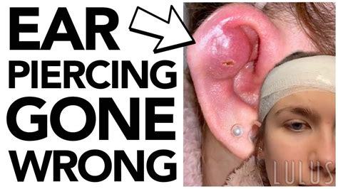 Infected Ear Piercing Gone Wrong Emergency Removal Youtube