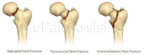 Hip Joint Fracture Classification Types Causes Symptoms Signs Treatment