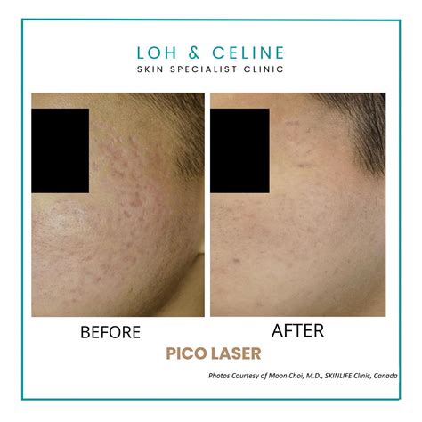 Pico Laser Loh Celine Skin Specialist Clinic