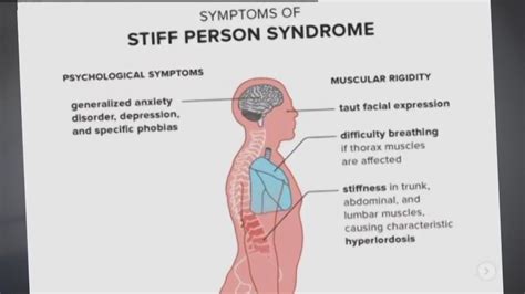 What Is Stiff Person Syndrome