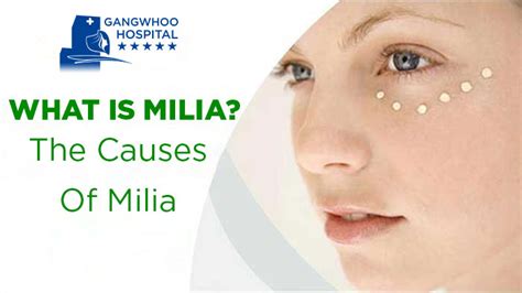 Milia Treatment – How To Get Rid Of Small While Bumps - Gangwhoo ...