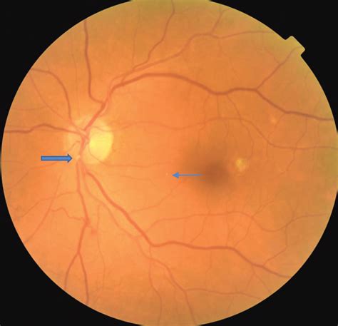 Central Retinal Artery Occlusion Anatomy