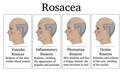 Dealing With Rosacea Charleston Dermatology