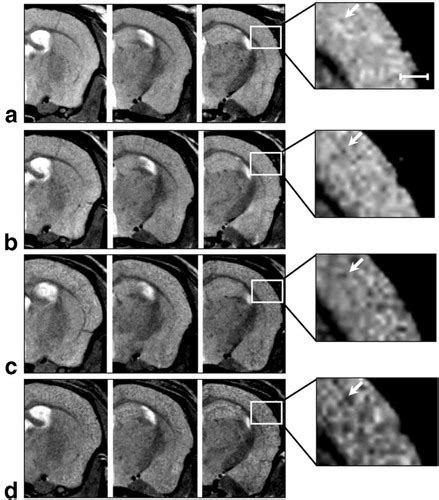 Longitudinal Assessment Of Alzheimers β‐amyloid Plaque Development In