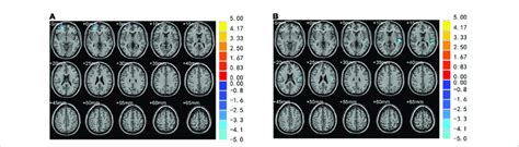 Brain Regions With Significantly Different VBM Values A Volume