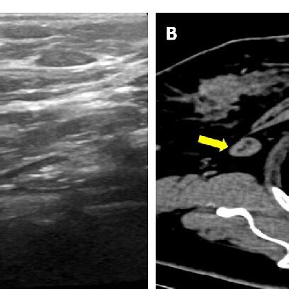 A 72 Year Old Female With Pathologically Proven Non Metastatic Axillary