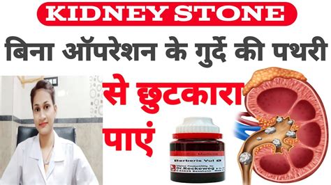 Homeopathic Medicine For Kidney Stone Pathri Ka Ilaj Pathri Ke