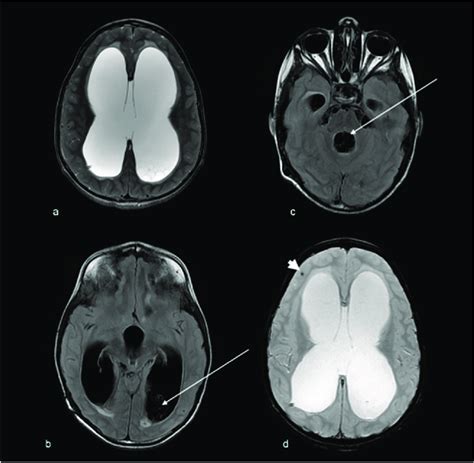 A T Axial Mri And B C Flair Axial Mri Brain Demonstrates Acute