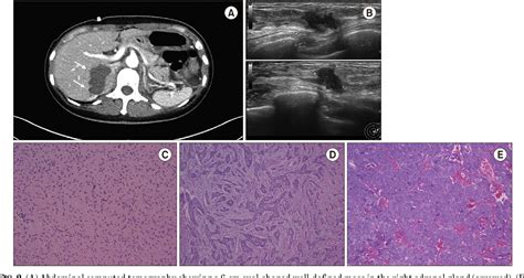 Figure 1 From An Extraordinary Case Of Pheochromocytoma With Breast Cancer In A Patient With