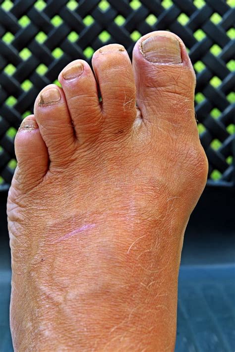 Valgus Do Hallux Do Bunion No Fundo Escuro Foto De Stock Imagem De