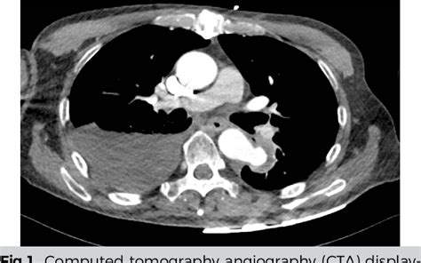 Figure 1 From Treatment Of A Descending Thoracic Mycotic Aneurysm