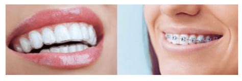 Why Is Invisalign Better Than Braces Medidental Care Dental Clinic