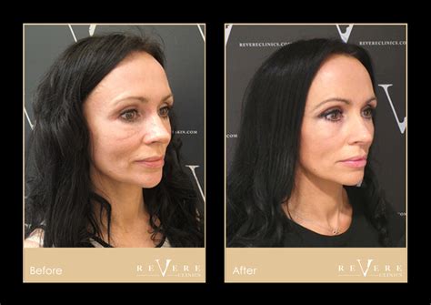 Filler Correction Dissolving Filler Revere Clinic