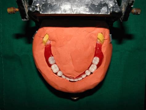 Teeth Arrangement In Neutral Zone Download Scientific Diagram