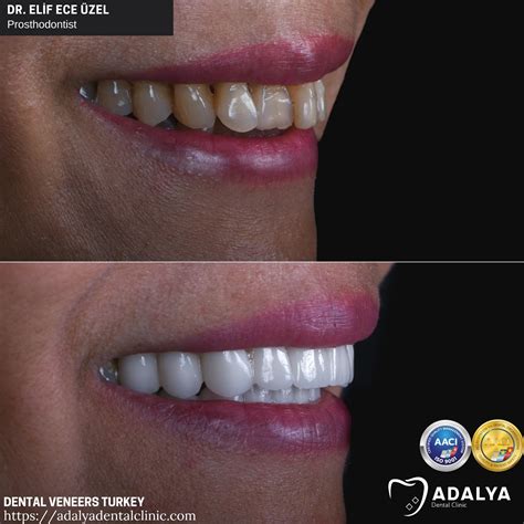 Dental Veneers Turkey Cost 2024 Porcelain Antalya Packages