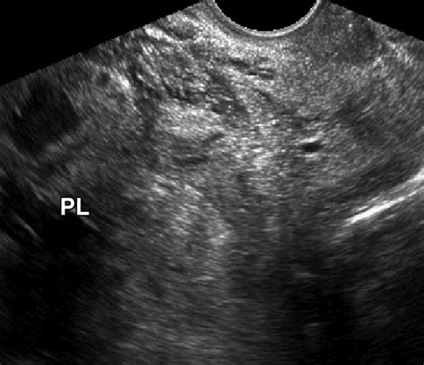 Placenta Previa 3d Ultrasound