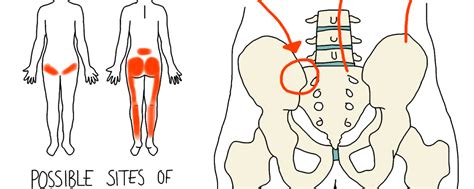 SIJ Pain and Pregnancy - Avin Patel Osteopathy & Medical Acupuncture Leicester, Wigston ...