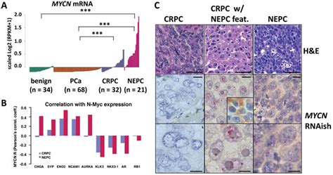 Mycn Expression In Prostate Cancer A Mycn Mrna Level In 34 Benign