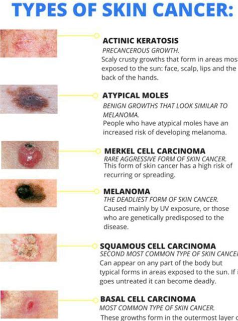 Types Of Skin Cancer Medizzy