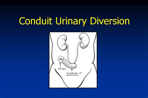 Urinary Diversions Ari D Silverstein Md Broward Ostomy Association