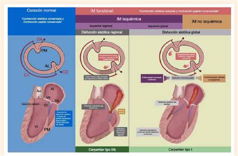 Mecanismos Y Clasificación De La Insuficiencia Mitral Funcional Se Download Scientific Diagram