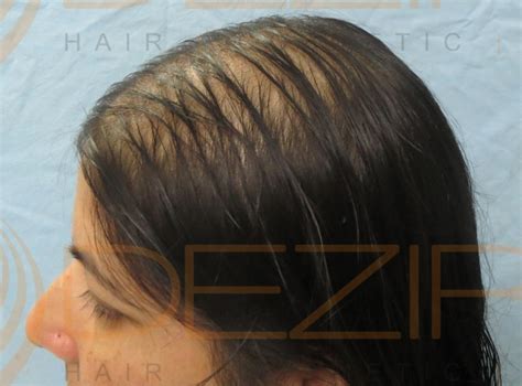 Female Pattern Hair Loss Done At Dezire Clinic Pune Hair Transplant Pune