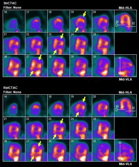 Data Driven Motion Correction Rescues Interpretation Of Rubidium Pet