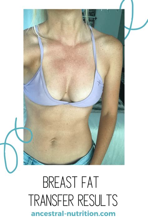 My Breast Fat Transfer Results Ancestral Nutrition