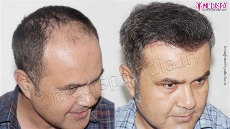 Best Hair Transplant Results Dubai Hair Transplant In Delhi Hair