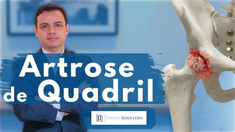 Artrose De Quadril Artrose De Quadril Tem Cura Sintomas E Tratamento