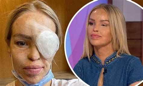 Katie Piper Reveals She Had Surgery To Close A Hole In Her Eye After Suffering Intolerable Pain