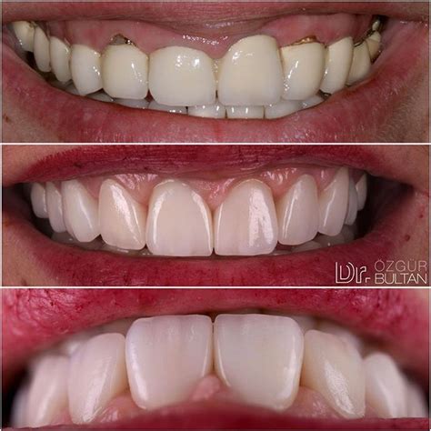 Existing Metal Ceramic Restorations Were Replaced With Ips E Max Crowns