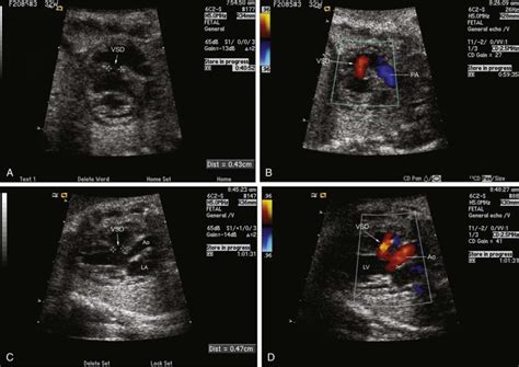 Ventricular Septal Defect Ultrasound