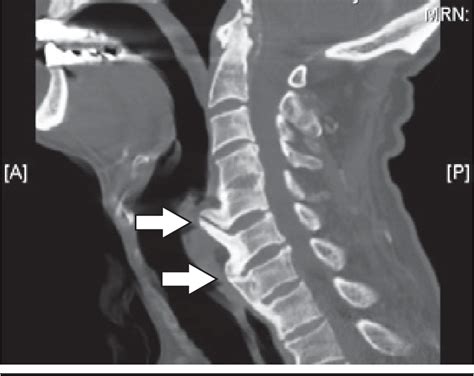 Bone Spur Symptoms I Bone Spur Treatments Home Remedico