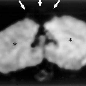 Bone Image Computed Tomography Scan Showing The Widened Diploic Space