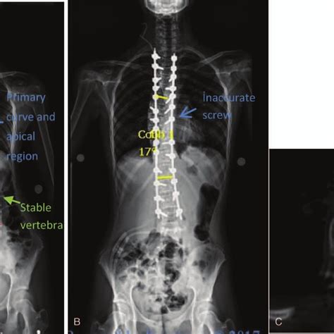 A A 13 Year Old Girl With Idiopathic Scoliosis Lenke Type 1 B The Download Scientific