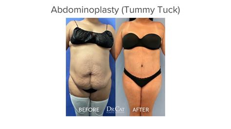 Tummy Tuck With Hernia Repair A Pubic Lift And Liposuction Of The Mons Pubis Youtube