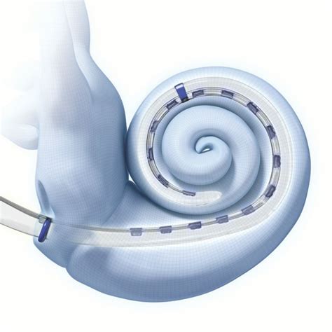 Internal Components of a Cochlear Implant | Cochlear implant, Cochlear ...