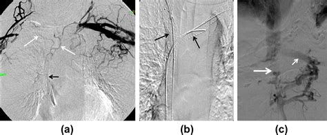 Imaging And Management Of Complications Of Central Venous Catheters